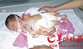 Em bé tám chân tay ở Trung Quốc