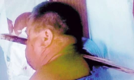 Một mình đến bệnh viện với thanh gỗ xuyên qua đầu