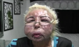 Khuôn mặt biến dạng vì tiêm dầu trẻ em