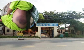 Học sinh lớp 1 bị cô giáo đánh bầm tím người