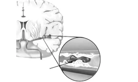 Huyết ứ gây thiếu máu não