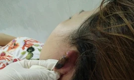 Nguy cơ bỏng da đầu, hoại tử vành tai của do làm đẹp.