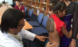 “Cô bé mai rùa” trước khi được phẫu thuật. Ảnh: Quốc Ngọc