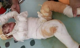 Bé Ngọc băng bó kín người quằn quại trong đau đớn