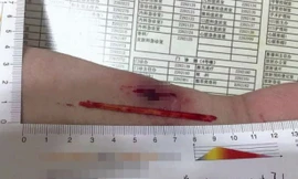 Đoạn đũa dài 8cm trong tay ông Zeng.