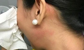 Tiếp viên T sau khi bị ông Mai Thanh Bình đánh