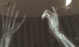 Ảnh chụp X-quang bàn tay bị đứt ngón của Peng.