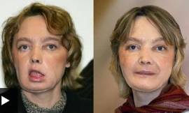 Hình ảnh Isabelle Dinoire sau (trái) và trước phẫu thuật.