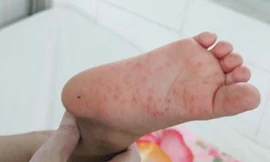 Lại thêm trẻ tử vong vì bệnh tay chân miệng
