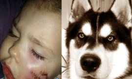 Bé gái 3 tuổi bị chó cắn nát 1 bên mặt