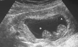 Phát hiện bé gái 14 tuổi sinh con, bệnh viện trình báo công an