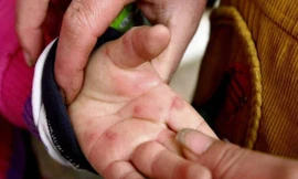 Ấn Độ cảnh báo xuất hiện loại virus mới gây bệnh 'cúm cà chua'