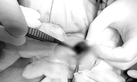 Bé trai 2 tuổi phải cắt bỏ tinh hoàn, cha mẹ chết lặng vì bỏ qua dấu hiệu cảnh báo này