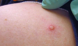 Lên tới 15.300 ca bệnh, WHO cân nhắc coi đậu mùa khỉ là ‘khủng hoảng toàn cầu’