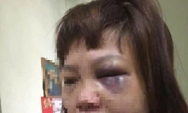 Ghen tuông, chồng tra tấn chém rách đùi vợ