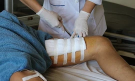 Bình rượu 20 lít phát nổ, người đàn ông bị đứt cơ chân