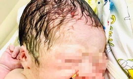 Hy hữu bé trai chào đời cùng vòng tránh thai của mẹ