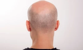 Không cấp phí mua tóc giả cho đàn ông hói