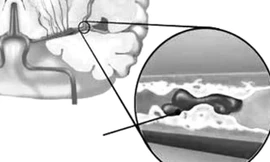 Huyết ứ gây thiếu máu não.