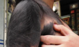 Bé gái 5 tuổi mọc lông đầy người