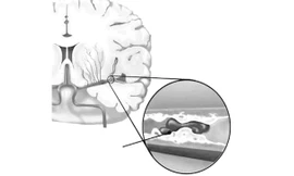Huyết ứ gây thiếu máu não.