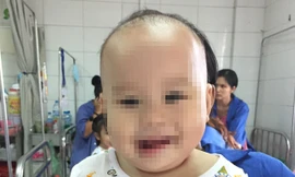 Bệnh Whitmore dễ bị chẩn đoán nhầm