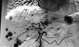 Thuốc nhuộm chỉ ra các khối đa ổ trong gan của bệnh nhân, trên phim chẩn đoán hình ảnh cho thấy từng khối thực thể tập trung tại các đầu mao mạch.
