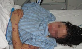 Nữ sinh hôn mê vì mắc viêm não mô cầu