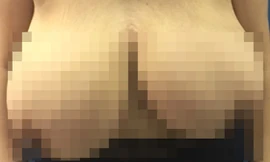 Phẫu thuật cho bệnh nhân có bộ ngực khổng lồ