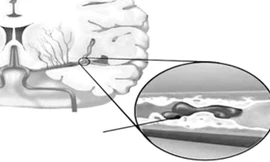 Huyết ứ gây thiếu máu não.