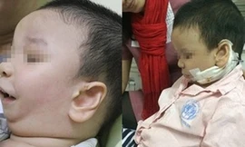 Kéo dãn xương hàm điều trị dị tật bẩm sinh