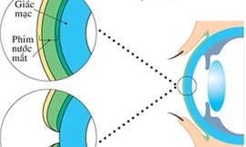 Khô mắt dễ dẫn đến mù lòa