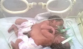 Cặp song sinh dính nhau đang được chăm sóc đặc biệt tại khoa Hồi sức Bệnh viện Việt Đức. Ảnh hai bé lúc mới chào đời do bệnh viện cung cấp. 