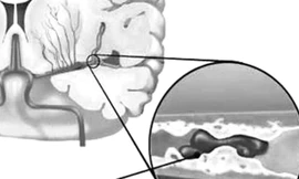 Huyết ứ gây thiếu máu não.