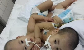 Hai em bé dính liền tim, gan ở Sài Gòn được tách rời