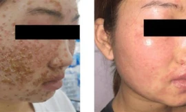 Bệnh nhân trước và sau 5 ngày điều trị 