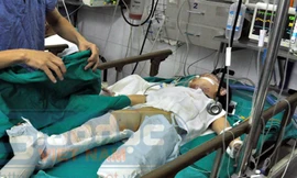 Sức khỏe cháu bé vụ nổ xe máy tiến triển tốt hơn