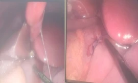 Hình ảnh trước và sau khi phẫu thuật mổ nội soi. Ảnh: Bệnh viện Trẻ em Hải Phòng