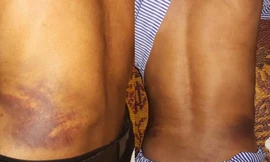 Vết thương bầm tím sau lưng ông Toàn