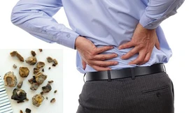 Những ai có nguy cơ mắc sỏi thận?