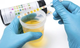 7 dấu hiệu cảnh báo nhiễm trùng bàng quang