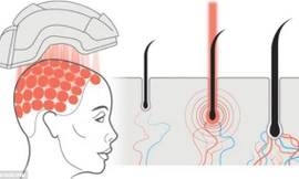 Mũ bảo hiểm giúp mọc tóc