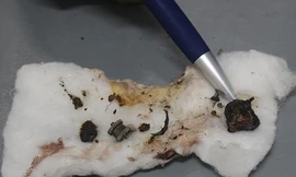 Các dị vật nằm trong phổi bệnh nhân được bác sĩ lấy ra ngoài. Ảnh: Đắc Thành. 