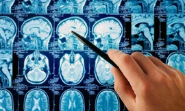 Những lầm tưởng phổ biến về thủ phạm gây ung thư