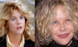 Những thảm họa nhan sắc vì 'dao kéo'