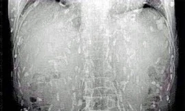  Tín đồ sushi bị sán 'làm ổ' khắp người