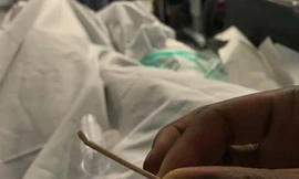 Que tránh thai 'đi lạc' tới tim, kẹt trong động mạch phổi suốt 2 năm