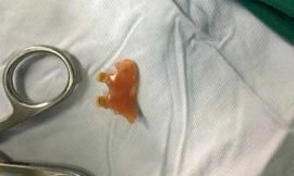 Một phần của hàm răng giả được lấy ra khỏi thanh quản bệnh nhân. Ảnh: Bệnh viện cung cấp. 