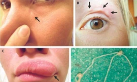 Người phụ nữ mà trước đó mới đi chơi ở ngoại ô Moscow và bị nhiều vết muỗi đốt… 