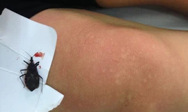 Nổi mề đay, tăng nhịp tim vì bọ xít đốt